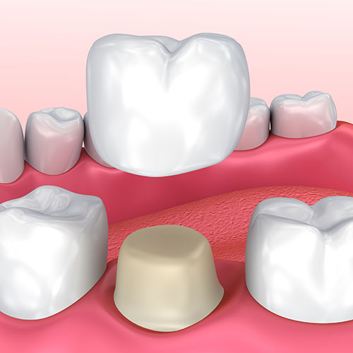 dental veneers