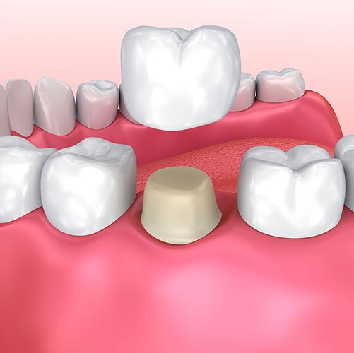 dental crown placement