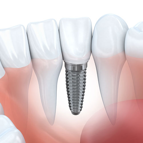 dental implant